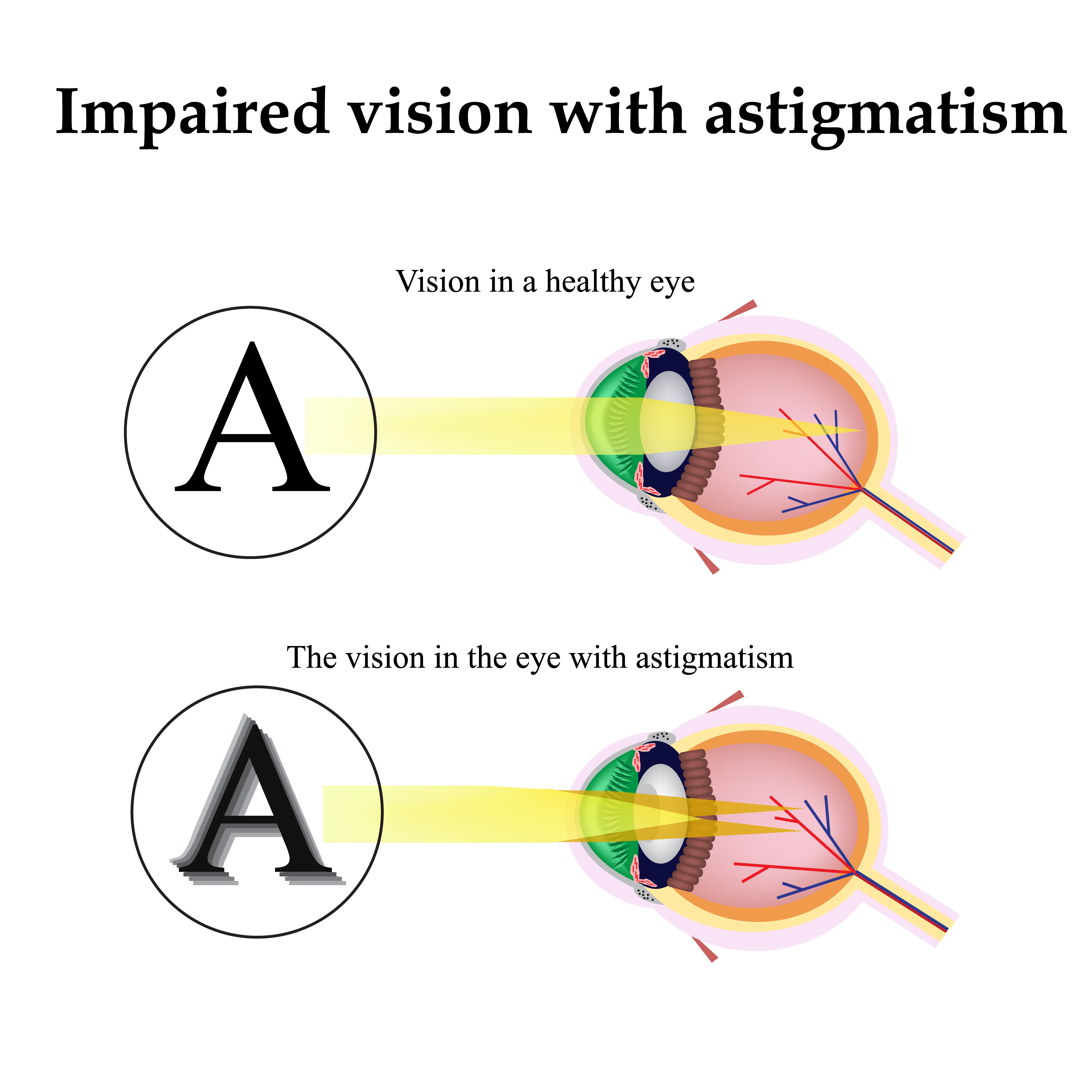Ive Got Astigmatism Can I Get Lasik Vision First 