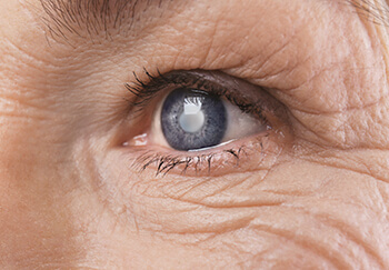 Closeup of Cataracts in the Eye