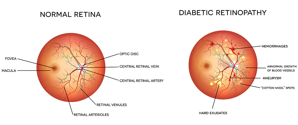 Chart Showing a Healthy Eye Compared to One With Diabetic Retinopathy