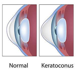 Healthy Eye Compared to One With Keratoconus